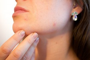 Różne problemy skórne – redukcja blizn potrądzikowych