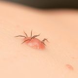 Wrastające włoski – objawy, przyczyny i skuteczne metody pielęgnacji
