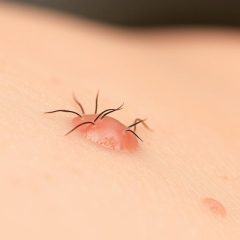 Wrastające włoski – objawy, przyczyny i skuteczne metody pielęgnacji