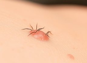 Wrastające włoski – objawy, przyczyny i skuteczne metody pielęgnacji