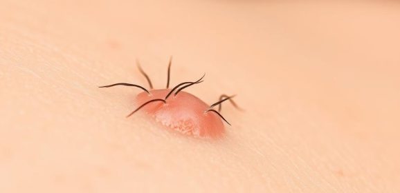 Wrastające włoski – objawy, przyczyny i skuteczne metody pielęgnacji