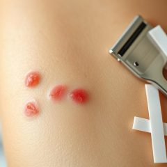 Blizny po wrastających włoskach: przyczyny, objawy i leczenie