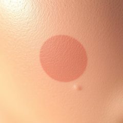 Hiperpigmentacja – przyczyny, objawy i metody leczenia skóry